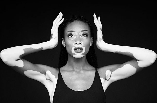 Winnie Harlow, a modell vitiligóval