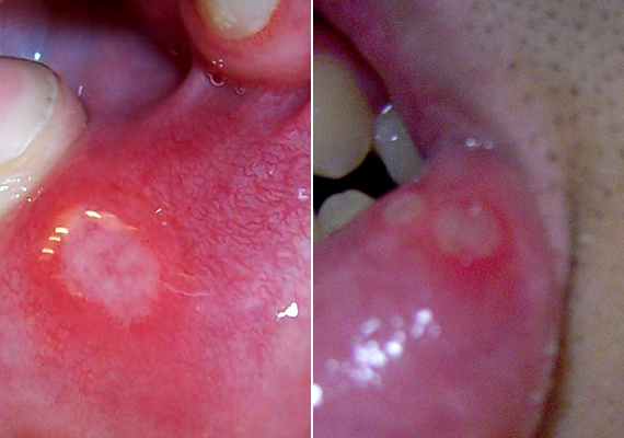 Nemi szemölcsök a száj nyálkahártyájában. Agresszív HPV típusok