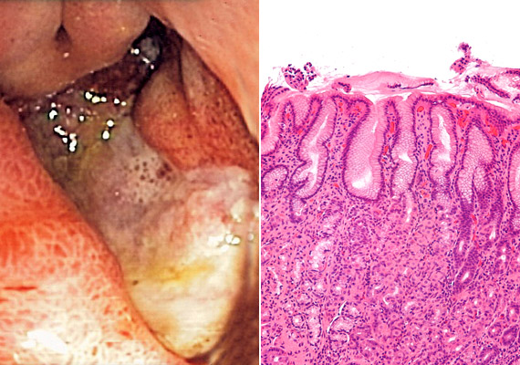 	A gasztritisz - vagyis gyomorhurut - a gyomor nyálkahártyájának gyulladását jelenti. Nemcsak a Helicobacter pylori, hanem a rendszeres alkoholfogyasztás is felelhet a kialakulásáért. A bal oldalon endoszkópos, míg a jobb oldalon mikroszkópos felvételt láthatsz a gyulladt gyomornyálkahártyáról.
