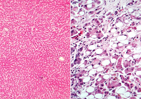 	A bal oldali képen egy egészséges máj mikroszkopikus képét láthatod, a jobb oldalon pedig a túlzott alkoholfogyasztás hatására kialakuló zsíros szöveti elfajulást.