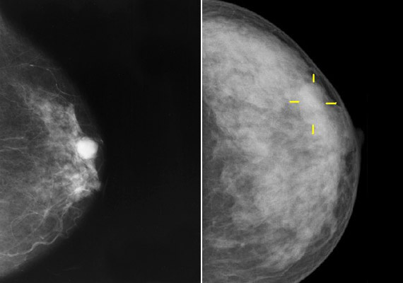 	Nem csak az emésztőrendszert és a bőrt károsítja a túlzott alkoholfogyasztás. A fenti képeken mammográfiai vizsgálat során felfedezett emlőrákot láthatsz. Kutatók szerint sajnos nők esetében komoly összefüggés mutatható az alkoholfogyasztás és a mellrák között.
