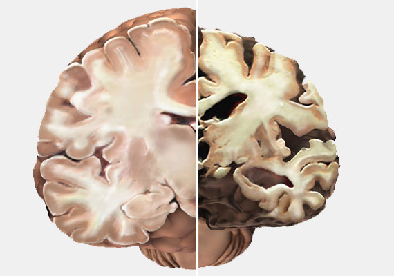 	A fenti összehasonlító kép is jól mutatja az egészséges és az alzheimeres agy közötti különbséget: a betegség következtében az agyszövet degenerálódik, az agyállomány csökken.