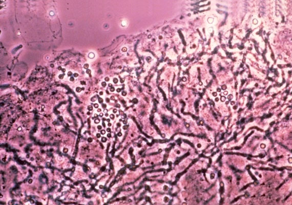 	A képen látható Pityrosporum - más néven Malassezia - a leggyakoribb, kézen előforduló gombafaj. Egyes fajtáit a fejbőrön a korpásodás kialakulásáért teszik felelőssé.