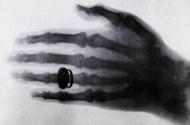 Anna Bertha Ludwig keze - a világ első röntgenfelvétele