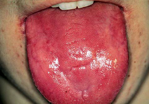 
                        	Érdemes arra is felfigyelned, ha túlzottan piros a nyelved, ez is lehet többek között a vérszegénység, illetve a vitaminhiány jele - ebben az esetben elsősorban a B12-vitaminé.