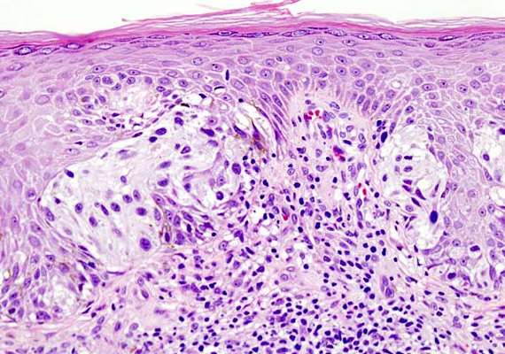 
                        	A mikroszkopikus felvételen melanomát láthatsz, a bőrszövetet hematoxilinnal és eozinnal festették meg. Korábbi cikkünkből megtudhatod, milyenek azok az atípusos anyajegyek, melyekből melanoma alakulhat ki.