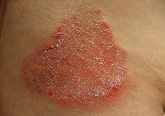 bőr gombás fertőzése