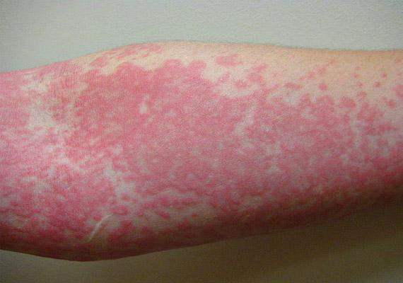 gombás bőrbetegségek