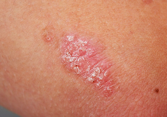 Eucerin®: A bőrről | Xerosis - tünetek, okok és megoldások