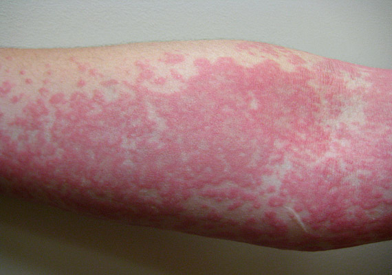 	A bőr szintjéből kissé kiemelkedő, viszkető csalánkiütés valamelyest hasonlít a szúnyogcsípésre, kialakulásának oka leggyakrabban valamilyen allergiás reakció. Jellemzően néhány óra - legfeljebb néhány nap - alatt elmúlik. A csalánkiütést akár aloe verával is orvosolhatod.