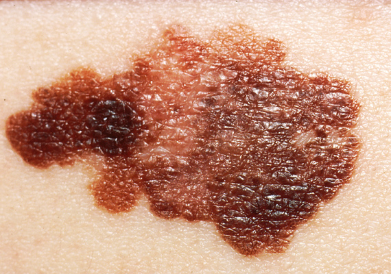 	A melanoma a szervezet pigmentsejtjeiből - a melanocitákból - alakul ki, jellemzően a testnek azon a részén, amelyet gyakran ér napfény. Leggyakoribb tünete a sötétedő vagy alakváltozást mutató anyajegy. Tudj meg róla többet!