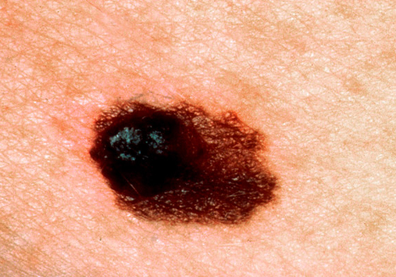 
                        	A festékes anyajegyekből kiinduló melanoma akár a fenti képen látható sötétebb bőrelváltozás formájában is felhívhatja magára a figyelmet. A betegség kialakulásában komoly szerepet játszik az UV-sugárzás. Kattints korábbi cikkünkre, és olvasd el a bőrgyógyász véleményét a szoláriumról!