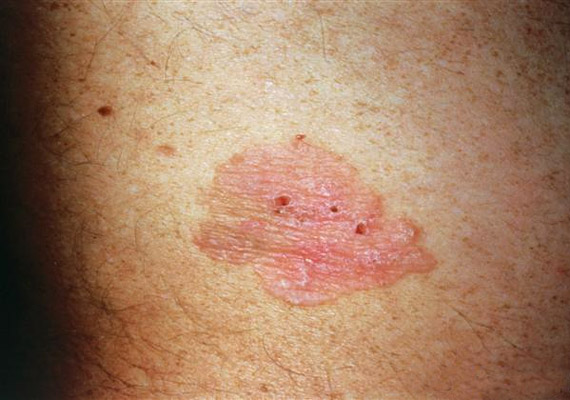 bőrrák tünetei összefolyó condyloma