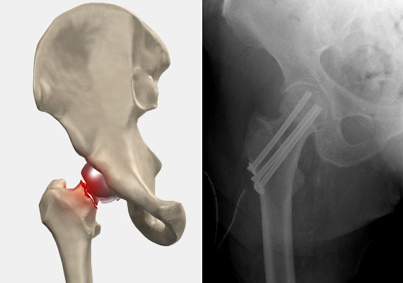 	A gerinc mellett a combnyakat is gyakran érinti a csontritkulás. Ezen a ponton nemritkán fordul elő törés, akár kisebb esések következtében is. Ha pedig műtétre kerül a sor, a röntgenképen gyakran láthatóak a későbbiekben a fenti, jobb oldali fotón is megfigyelhető csavarok.