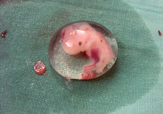 
                        	A fotón egy hathetes embriót láthatsz, amely sajnos méhen kívül fejlődött.