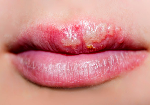 	Az ajkakon fájdalmas, folyadékkal teli hólyagok, illetve a szájüregben és a torokban fekély formájában jelentkező herpeszt általában a Herpes simplex-1 vírus okozza. Sajnos ha már egyszer kialakult, többször is jelentkezni fog. Tudd meg, milyen természetes módszerekkel tehetsz ellene!