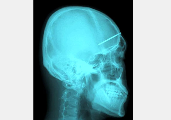 	Ez a dél-koreai férfi fejfájással fordult orvosához.