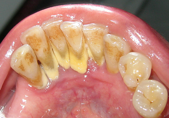 	A fogorvosok a fogágybetegséghez vezető fogínygyulladás egyik legjellemzőbb okaként említik a fogkövek kialakulását, illetve azt, ha azokat a páciens nem távolíttatja el megfelelő időközönként. A rendszeres fogorvosi szűrés tehát elengedhetetlen feltétele a betegség megelőzésének.