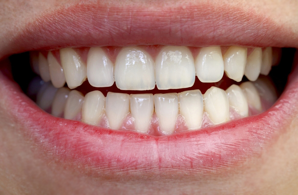 Így lehetnek fehérebbek a fogaid | Well&fit