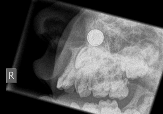 
                        	A gyerekek röntgenfelvételeit vizsgáló orvosoknak is gyakran kell idegentestekkel szembesülniük, a képen például egy orrba dugott gombelem látható.
