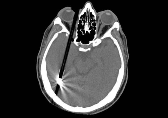 	Ezen a CT-felvételen egy, a koponyába hatoló toll látható. Szerencsére a pácienst sikerült megmenteni.