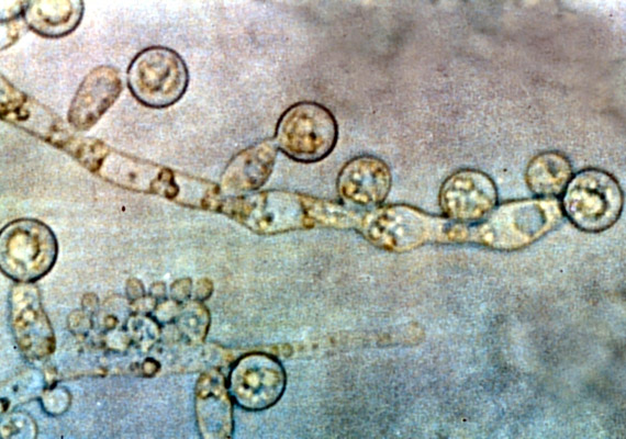 	A Candida albicans egy ideig az emberi szervezeten kívül is életképes marad - a meleg víz például kedvez neki. A szervezetben elszaporodva számos kellemetlen panaszt okoz.