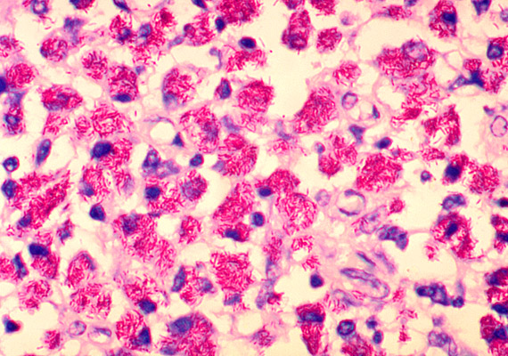 	A képen látható rózsaszínes minta akár egy vidám tapétának is elmenne, pedig valójában a Mycobacterium avium mikroszkopikus fotóját látod. A zuhanyrózsában gyakran tanyázó kórokozó gyengítheti az immunrendszert, illetve növelheti a légúti fertőzések kialakulásának esélyét.