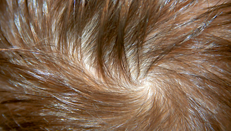 Vörös viszkető foltok a fejbőrön a haj alatt. Fejbőr gombásodása – Tünetek, típusok és teendők