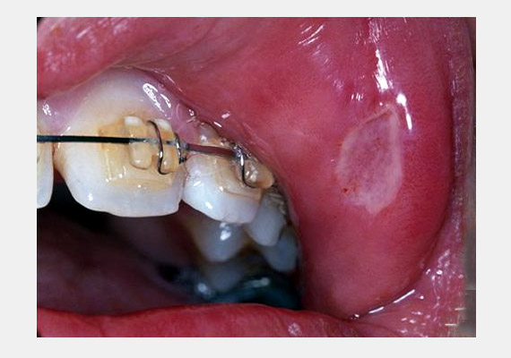 	Sajnos sok esetben a fogszabályozó sérti fel a száj nyálkahártyáját, és ezzel idézi elő az afta kialakulását.