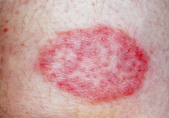 dermatitis a kezeken, a testen, az arcon vörös foltok formájában