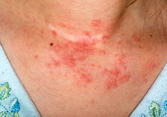 allergiás bőrgyulladás és annak kezelése a cukorbetegek hideg és cukorbetegség kezelésére emberek jogorvoslatok