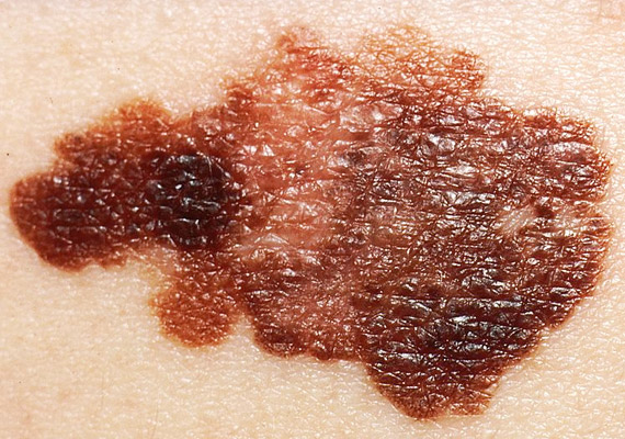 	A melanoma a szervezet pigmenttermelő sejtjeinek, a melanocitáknak az elváltozása. Kiindulhat már meglévő anyajegyből, de sima bőrfelületről is, pontosan ezért nehéz felismerni a kezdődő betegséget. Tudj meg többet róla!