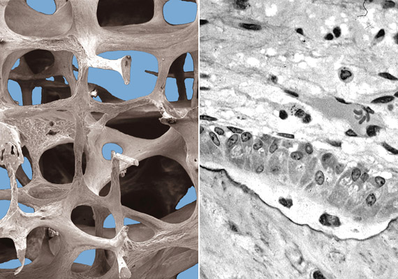 	Balra a csontritkulás eredményeképpen létrejövő hálószerkezetű, törékeny csontállományt láthatod, a jobb oldali képen pedig az aktív oszteoblasztokat, vagyis csontképző sejteket. Tudj meg többet a betegség okairól!