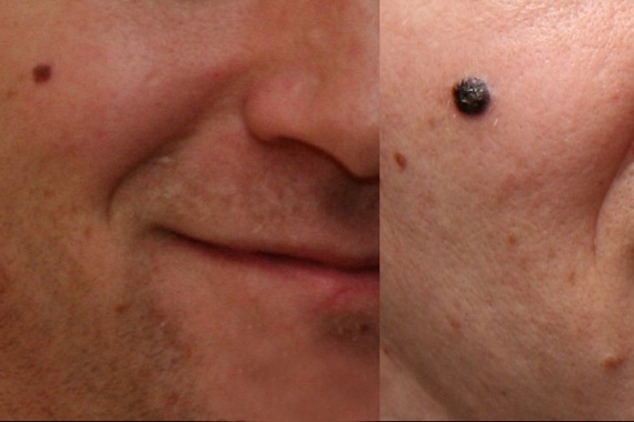 	A bal oldali képen látható elváltozásból alig több mint egy év alatt alakult ki a jobb oldali képen látható, jellegzetes tüneteket mutató melanoma.