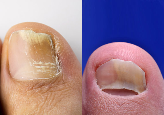 kezelése ujjak és a körmök alatt cukorbetegség sensor diabetes