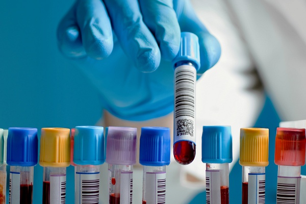 Mennyi az ideális vércukorszint? 7 adat a laborleletben, amit ismerned kell