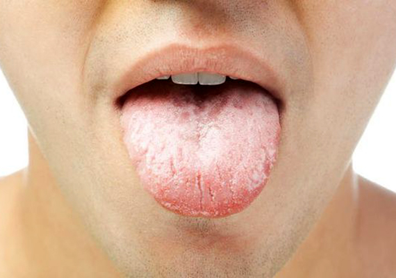 lepedék a nyelven, fehér szag a szájból baba ételallergia tünetei
