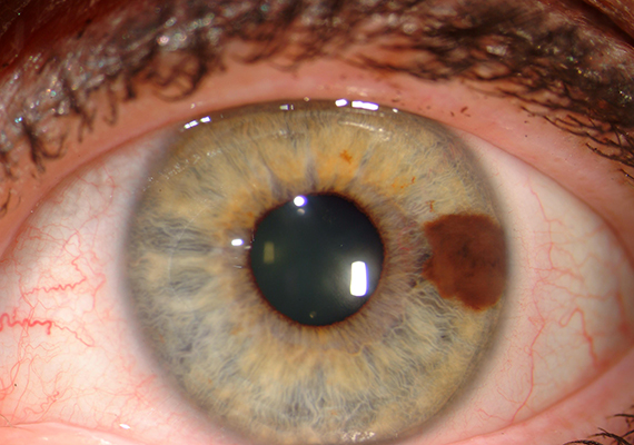 vörös pelyhes foltok jelentek meg a szemhéjon a leghatkonyabb gygynvnyek pikkelysömör felülvizsgálata
