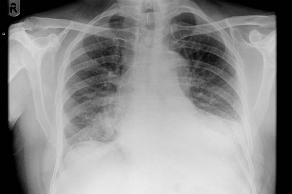 	A kép bal oldalán látható halvány vonal egy pacemaker orvosi kábele, melyet a páciens mellkasában felejtettek, miután az eszközt már eltávolították.