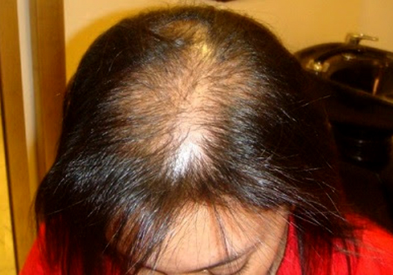 A női hajhullás okai és ellenszere - DR. IMMUN
