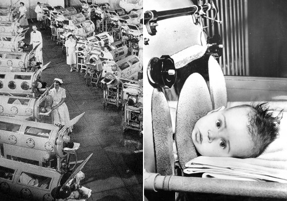 
                        	A vastüdőt legelőször egy bostoni kórházban használták 1928-ban. Az eszköz - a belső légnyomás szabályozott váltakozásával - segítette a járványos gyermekbénulásban szenvedők légzését. Hazánkban 2005-ben cserélték le az utolsó vastüdőt.