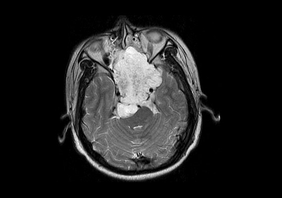 
                        	A fenti agyi felvételen jól kivehető egy nagy fehér folt. A daganat neve cordoma, amely hivatalosan ugyan nem agydaganat, mivel nem agyi sejtekből, hanem csontból indul ki, ám növekedése éppúgy veszélyezteti a koponyaűri szerveket.
