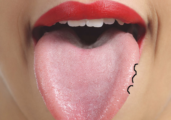 	Ha a nyelv bal oldalán figyelsz meg fogbenyomatokat, az a máj funkciózavarára hívhatja fel a figyelmet. Korábbi cikkünkben megnézheted, mit tesz az alkohol a májaddal.