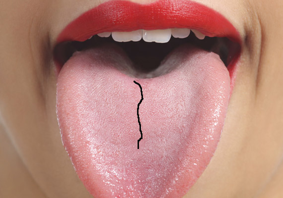 A nyelv közepén megfigyelhető repedés általában emésztési rendellenességekre utal. Ha gyakran puffadsz, emésztésed lelassult, fogyassz több folyadékot és a rostos táplálékot.