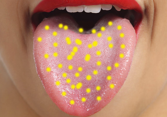	Ha a sárgás-fehéres lepedék az egész nyelvedet beborítja, szinte biztosra veheted, hogy Candida-fertőzésed van. Tovább erősítheti a megérzésedet, ha puffadsz, illetve a tested több pontján viszkető-vöröses gombás fertőzés jelenik meg. A gyógyszeres kezelés mellett érdemes kipróbálnod a Candia-diétát.