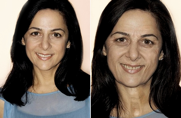 Botox vagy hyaluronsav: melyiket válasszuk?