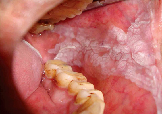 5 dolog, amit nem tud a szájüregi rákról - Artdent Dohánytól származó szájüregi rák