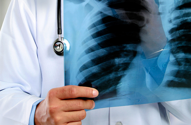 tüdő tuberkulózis fogyás