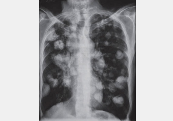 röntgen a tüdőről magas vérnyomás esetén)