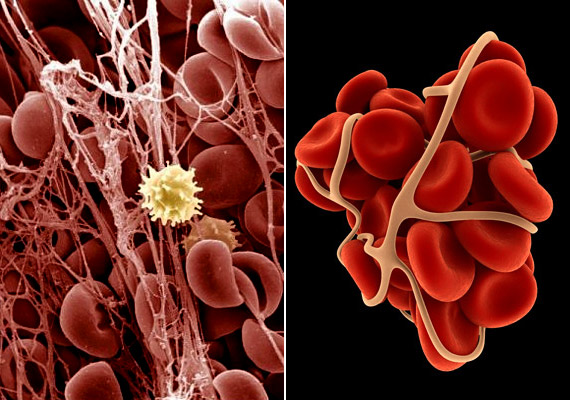 
                        	Ha a vér sejtes elemei összecsapódnak, egymáshoz ragadnak, vérrög jön létre, ami trombózishoz vezethet. Kialakulását okozhatja a véráramlás lelassulása, az érfal legbelső rétegének sérülése, valamint a vér alvadási készségének fokozódása.